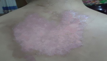 散发型白癜风有什么发病特点