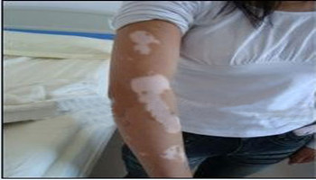 胳膊白癜风黑色素脱失的原因