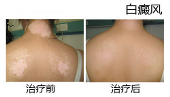 白癜风治好的效果图