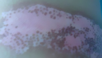 手指按压变红的白斑就是白癜风吗