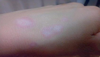 儿童白癜风都伴有哪些症状