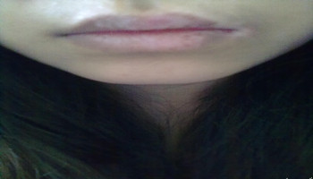 解读嘴角白癜风黑色素脱失的原因