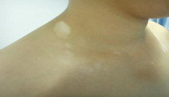 黑色素种植能快治好白癜风吗