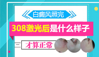 <strong>别担心，白癜风并不可怕</strong>