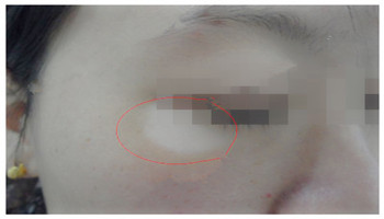 孕妇患有白癜风也有注意事项