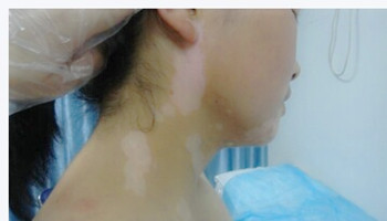 青少年白癜风早期治疗方法怎样选择