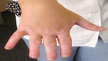 孕妇手指白癜风症状