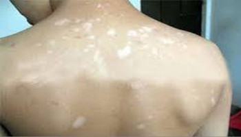 儿童后背长白癜风要怎么治疗