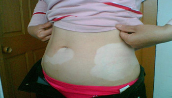 腰部白癜风扩散了该怎么办