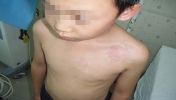 儿童白癜风该如何治疗呢