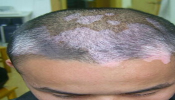 头上患上白癜风这种病要怎么治