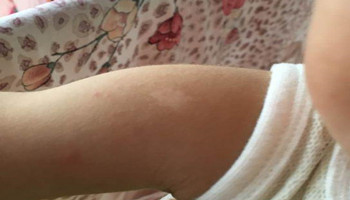 青少年胳膊白癜风早期症状