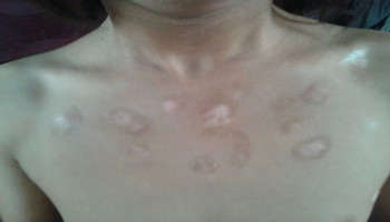 青少年胸部白癜风早期症状