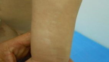 治疗胳膊白癜风有哪些有效方法