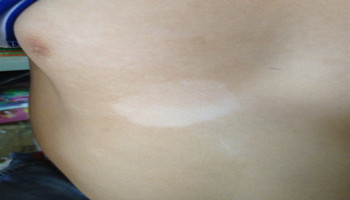 青少年胸口白癜风早期症状