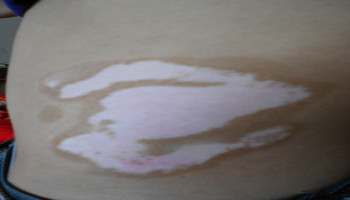 治疗腰部白癜风有哪些有效方法