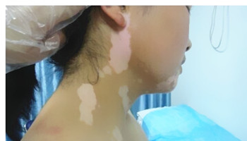 治疗青少年儿童背部白癜风的方法是什么