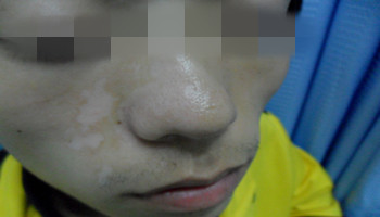 治疗鼻子白癜风有哪些有效方法