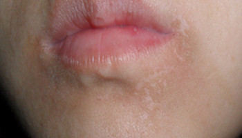 嘴唇白斑早期图片图片