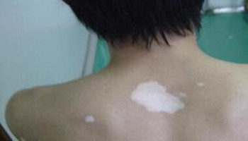 脖子上有白斑要怎么办