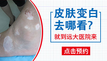 泛发性白癜风症状表现是什么