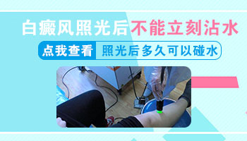 多久能治好白癜风
