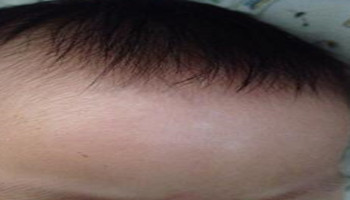 小孩额头长小白斑点事怎么回事