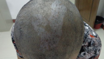 毛囊型白癜风早期能治好吗