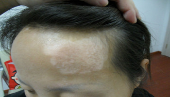 女性脸部白癜风激光治疗照射几次