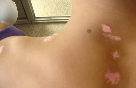 为什么手上很容易出现白癜风