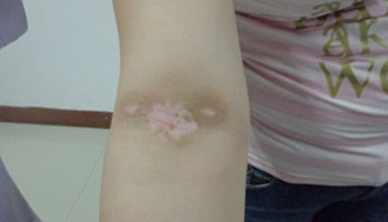 白癜风早期能用308激光治疗吗