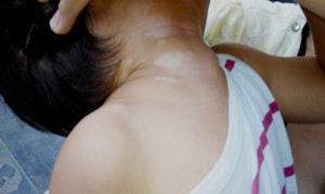 孩子脖子上长白斑怎么办