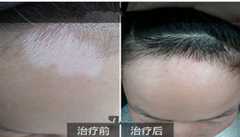 女性白癜风能不能治好