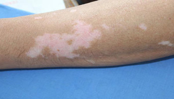 白癜风的白斑抹药后发红正常吗