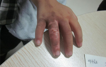 不担心“出手”，治疗手部白癜风这样效果更好!