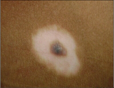 白癜风怎么得的 有可能是白癜风