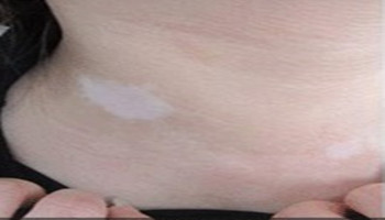 女性颈部白癜风早期治疗308激光能照好吗