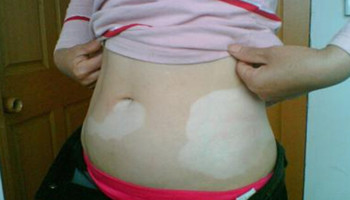 女性白癜风夏季要如何护理皮肤