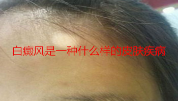 白癜风是一种什么样的皮肤疾病