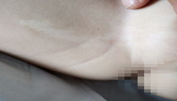 大腿根部白癜风这病怎么治疗