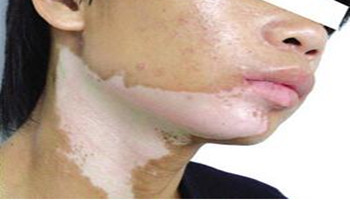 长在脖子上的散发型白癜风怎么才能治疗康复