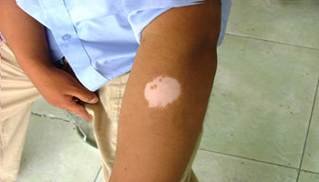 胳膊白癜风怎么治疗比较好