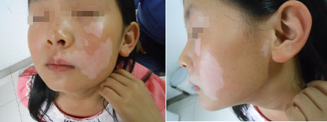 如何有效的治疗孩子身上的白癜风