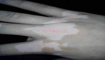 扩散中的白癜风能直接照激光治疗吗