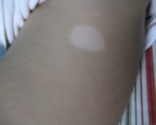 白癜风可以打激素针吗