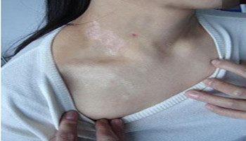 女性白癜风早期能治好吗症状是什么