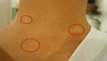 脖子上白癜风怎么治疗比较好呢