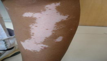 腿上有小白点是白癜风造成的吗