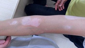 白癜风治疗的时候应该注意什么