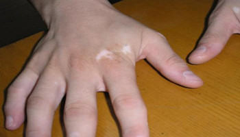 常见手部白癜风治疗怎么做能好